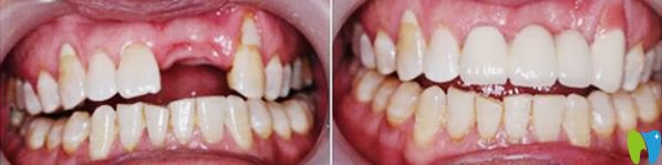 深圳瑞爾齒科種植牙效果