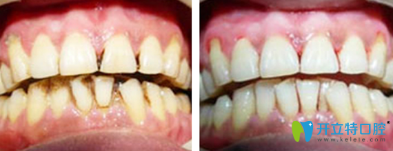 深圳諾得口腔張榮水牙周病治療前后對(duì)比圖
