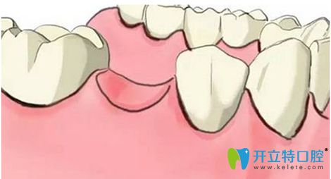 拔牙后多久可以鑲牙？鑲牙的價(jià)格大概需要多少錢？