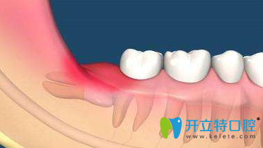 智齒牙齦腫痛怎么辦？分享牙齦快速消腫止痛小妙招