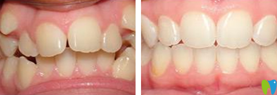 深圳諾德齒科時(shí)代天使隱形矯正案例