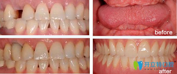 深圳拜博口腔單顆牙及全口牙缺失種植效果