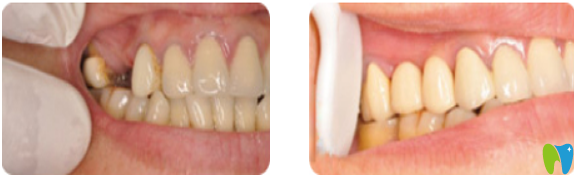 深圳諾德口腔怎么樣？諾德齒科種植牙案例前后對比圖