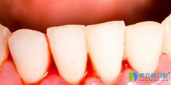 深圳拜博口腔解析：刷牙時牙齦出血是什么原因該怎么治療