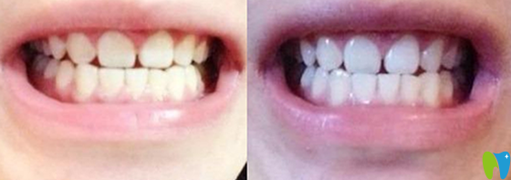 諾德口腔潔牙前后對(duì)比照片效果展示