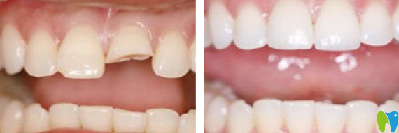 深圳諾德齒科牙齒修復(fù)前后對比照片