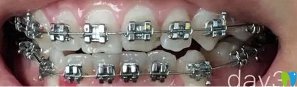 深圳瑞爾齒科牙齒矯正一個月效果