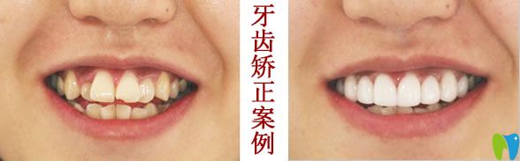 <!--<i data=20240703-sp></i>-->牙齒矯正前后對比效果