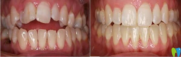28歲男士矯正牙齒前后對(duì)比照