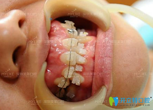 美萊口腔半隱形矯正帶牙套過(guò)程 美萊口腔半隱形矯正帶牙套過(guò)程