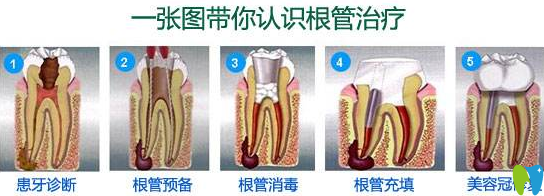 廣州穗江口腔醫(yī)生揭秘顯微根管治療費用及治療步驟