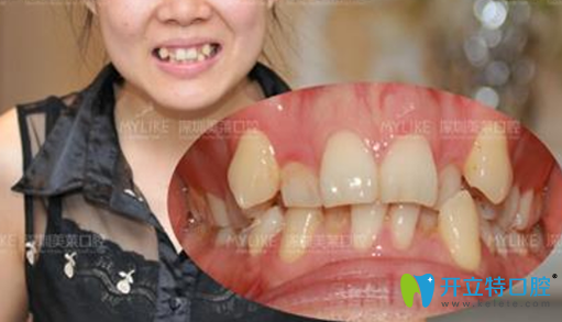 深圳美萊口腔牙齒矯正術(shù)前照 深圳美萊口腔牙齒矯正術(shù)前照