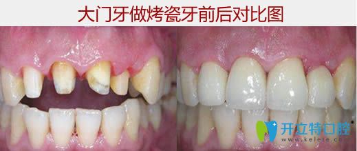大門牙烤瓷前后對比圖