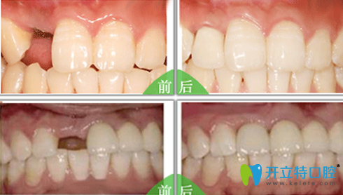 廣州穗江口腔種植牙前后效果對(duì)比圖