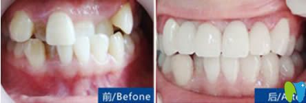 深圳拜博金屬牙齒矯正前對(duì)比照