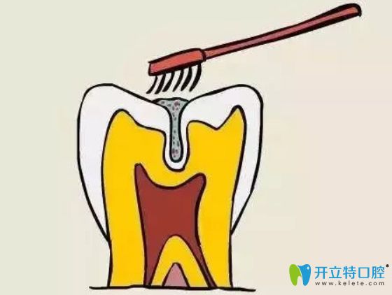 孩子幾歲做窩溝封閉合適？做完窩溝封閉后還會(huì)長蛀牙嗎？