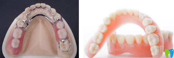 廣州佳美口腔分享：假牙材料哪種比較好 裝一顆假牙多少錢