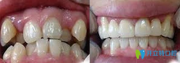 博愛口腔牙齒矯正效果圖