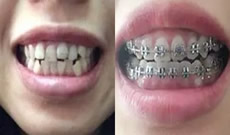 齙牙怎么矯正?在深圳汪洋齒科做牙齒正畸4個月就能去牙套啦