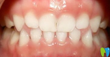 歡樂口腔乳牙反頜矯正效果 歡樂口腔乳牙反頜矯正效果