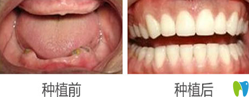 蒙恩齒科黃美華全口牙種植前后效果對(duì)比圖 蒙恩齒科黃美華全口牙種植前后效果對(duì)比圖