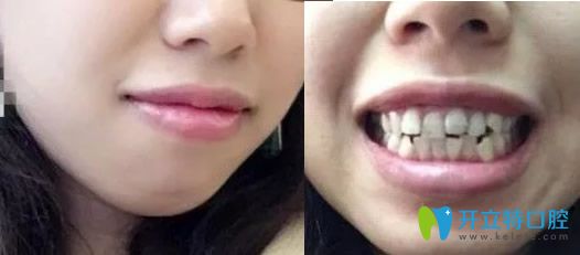 沒(méi)在深圳汪洋齒科口腔做牙齒矯正前照片