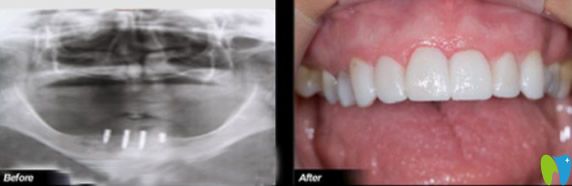 歡樂口腔種植牙 歡樂口腔種植牙