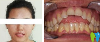 我在深圳蒙恩齒科做隱適美牙齒矯正之前的照片 我在深圳蒙恩齒科做隱適美牙齒矯正之前的照片