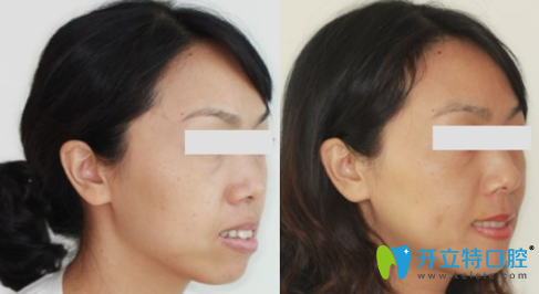 蒙恩齒科程碧煥隱形牙齒矯正前后效果對(duì)比圖