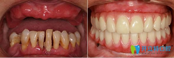 鄭州雅美口腔微創(chuàng)種植牙效果圖