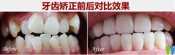 28歲顧客時代天使矯正前后對比照