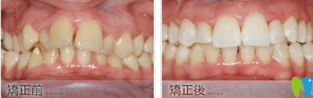 長(zhǎng)沙雅美口腔牙齒矯正前后效果對(duì)比圖 長(zhǎng)沙雅美口腔牙齒矯正前后效果對(duì)比圖