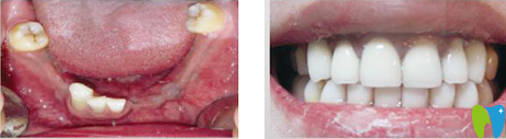 長(zhǎng)沙雅美口腔種植牙前后效果對(duì)比圖 長(zhǎng)沙雅美口腔種植牙前后效果對(duì)比圖