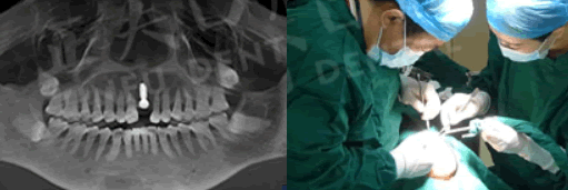 深圳正夫口腔種植牙過程圖 深圳正夫口腔種植牙過程圖