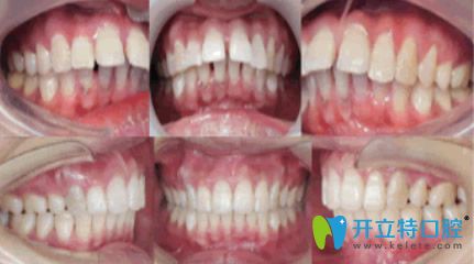 杭州牙科矯正牙齒效果