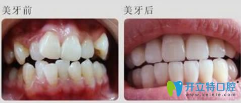 廣州華美李醫(yī)生隱適美矯正前后對比效果】