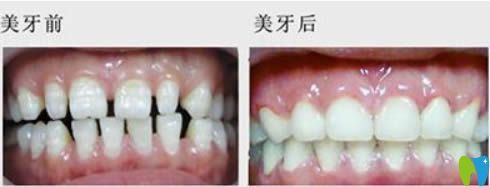 廣州華美口腔李敏華牙齒稀疏矯正前對比圖