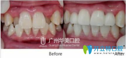 青少年虎牙矯正前對比圖