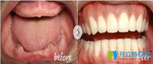 廣州雅皓齒科全口牙缺失修復(fù)對(duì)比圖