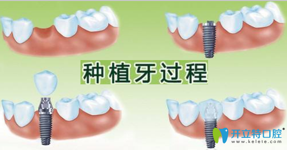 廣州廣大口腔牙齒種植醫(yī)生來(lái)簡(jiǎn)述種植牙的利與弊有哪些