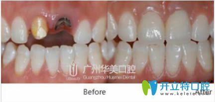 韓國奧齒泰種植牙前后對比照