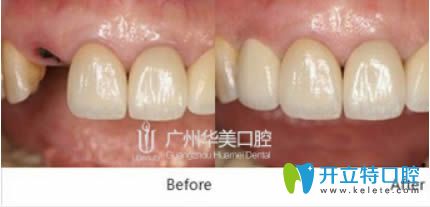 德國費亞丹種植牙前后對比效果