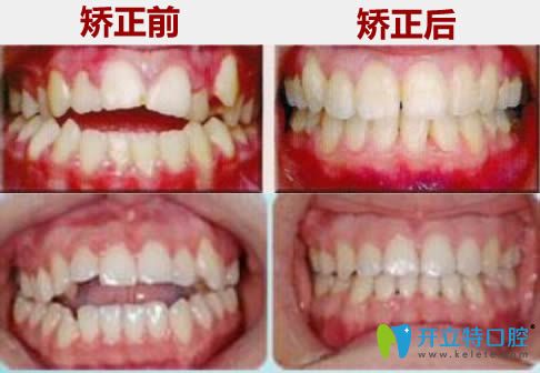 廣州華美前牙開頜正畸前后對比效果 廣州華美前牙開頜正畸前后對比效果
