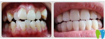 湛江致美口腔周秀紅牙齒矯正效果對比圖 湛江致美口腔周秀紅牙齒矯正效果對比圖