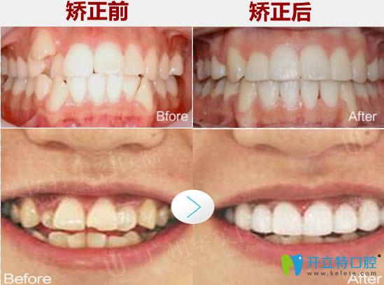 廣州華美口腔牙齒擁擠和虎牙矯正前后對比照 廣州華美口腔牙齒擁擠和虎牙矯正前后對比照