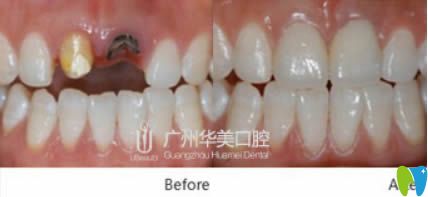 韓國奧齒泰種植牙前后對比效果