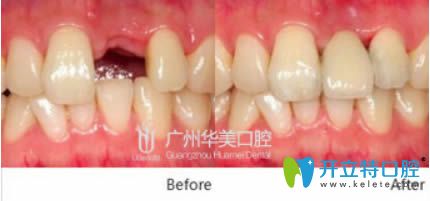 美國皓圣種植牙前后對比照