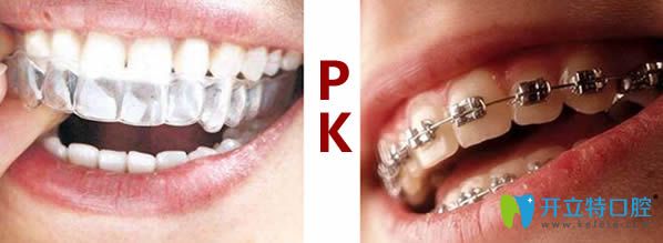 牙齒矯正中的牙箍和牙套有什么區(qū)別？通過比較來看哪個(gè)好
