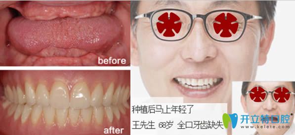 68歲老年人全口牙缺失即刻種植案例 68歲老年人全口牙缺失即刻種植案例