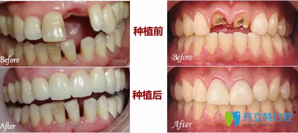 佛山中大口腔門牙缺失種植前后對比圖 佛山中大口腔門牙缺失種植前后對比圖